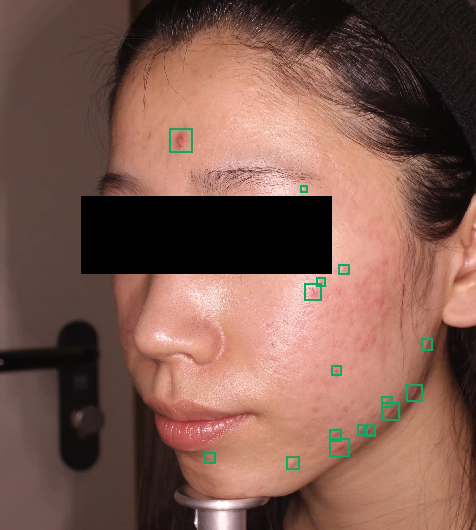 Lesion detection: bounding boxes identify inflammatory acne lesions